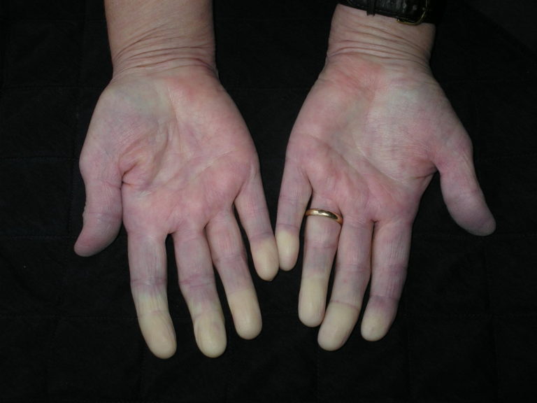 Sklerodermie-Raynaud-Syndrom-MEDIZINICUM