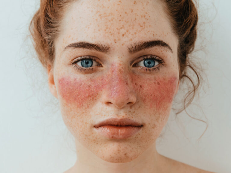 Systemischer Lupus Erythematodes | Krankheitsbilder Arztwissen ...